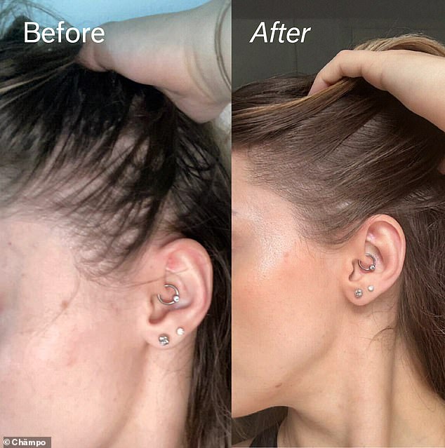 This user shows how Chmpo Pitta Growth Serum revived her thinning hair, revealing fuller, healthier strands