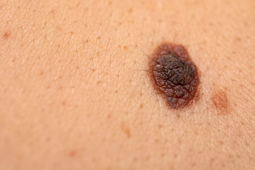 Exploring melanoma incidence and mortality rates calls for further research
